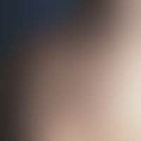 Lichen myxoedematosus: lichenoide, deutlich konsistenzvermehrte, hautfarbene bis gelblich-rötlich...
