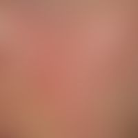 Plaque-like form of cutaneous mucinosis:&nbsp;Peau d´orange artige unscharf begrenzte, wenig symp...