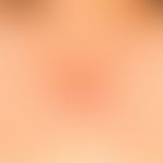 Differenzialdiagnose: Narbe, hypertrophische

Diagnose: Keloid; über die ursprüngliche Narbe hina...