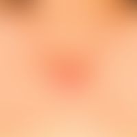 Differenzialdiagnose: Narbe, hypertrophische

Diagnose: Keloid; über die ursprüngliche Narbe hina...