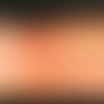 Lichtdermatose, polymorphe (Detailaufnahme):&nbsp; juckende, hochrote Papeln und Plaques wenig St...