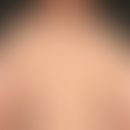 Lichtdermatose, polymorphe: charakteristisches Verteilungsmuster mit akzentuiertem Befall sonnenl...