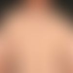 Lichtdermatose, polymorphe: charakteristisches Verteilungsmuster mit akzentuiertem Befall sonnenl...