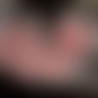 Enteropathie-assoziiertes T-Zell-Lymphom: kutane knotige Metastase am Kapillitium. Klinisch-morph...
