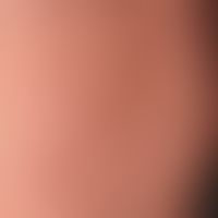 Lichen planus exanthematicus: seit mehreren Monaten bestehendes,&nbsp;juckendes Exanthem mit 0,1-...