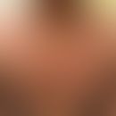 Eosinophiles anuläres Erythem: figuriertes Exanthem mit anulären und zirzinären, randbetonten&nbs...
