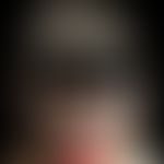 Eosinophile pustulöse Follikulitis: akneiformer Aspekt mit Papeln, Pusteln und Plaques. Bekannte ...