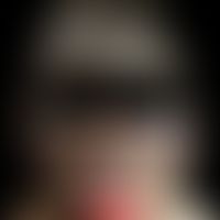 Eosinophile pustulöse Follikulitis: akneiformer Aspekt mit Papeln, Pusteln und Plaques. Bekannte ...