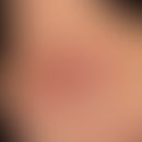 Abszess: fluktuierender schmerzhafter prall-elastischer, schmerzhafter Knoten. Seitlicher Halsber...