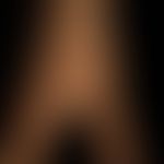Naevus verrucosus unius lateralis: diskrete, völlig symptomlose, leicht erhabene, etwas raue,&nbs...