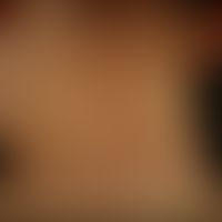 Naevus verrucosus unius lateralis: diskrete, völlig symptomlose, leicht erhabene, etwas raue,&nbs...
