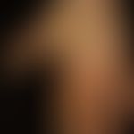 Naevus verrucosus unius lateralis: diskrete, völlig symptomlose, leicht erhabene, warzenartig rau...