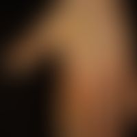Naevus verrucosus unius lateralis: diskrete, völlig symptomlose, leicht erhabene, warzenartig rau...
