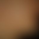 Naevus verrucosus unius lateralis: diskrete, völlig symptomlose, leicht erhabene, etwas raue,&nbs...