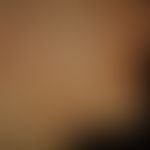 Naevus verrucosus unius lateralis: diskrete, völlig symptomlose, leicht erhabene, etwas raue,&nbs...