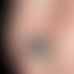 Differenzialdiagnose subunguales Melanom

Diagnose:&nbsp; Nagelhämatom. Nach vorne scharf begrenz...