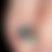Differenzialdiagnose subunguales Melanom

Diagnose:&nbsp; Nagelhämatom. Nach vorne scharf begrenz...