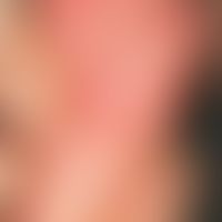 Peeling Skin Syndrom: generalisiertes gering&nbsp;entzündliches (erythrodermisches) Krankheitsbil...
