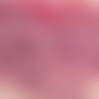 Kongenitale selbstheilende Histiozytose: dichtes monezytäres, epidermotropes&nbsp;Infiltrat in de...