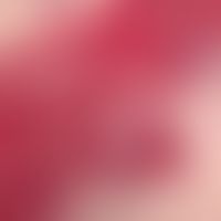 Kongenitale selbstheilende Histiozytose:&nbsp;CD1a-Reaktivität des Infiltrates. Abb. entnommen au...