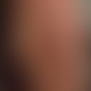 Histiozytose der indeterminierten Zelle: ausgedehntes Krankheitsbild mit Papeln und konfluierten ...