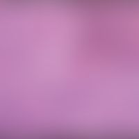 Histiozytose progressive noduläre: dichte aggregation von Schaum- und Riesenzellen. Abb. entonmme...