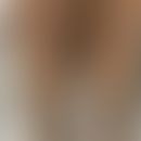 Rosai-Dorfman-Krankheit, familiäre: Flächige Hyperpigmentierungen und Hypertrichose

