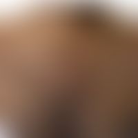 Xanthoma disseminatum: chronische Form der Xanthogranulomatose mit symmetrisch verteilten, hier r...