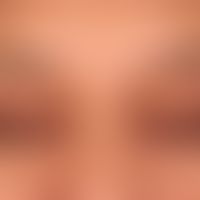 Xanthelasmen beider Lider: &nbsp;flache gelbliche Einlagerungen von Lipiden in die Lidhaut. Der P...