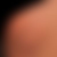 Adultes Xanthogranulom: mäßig feste, stellenweise verruköse hautfarbene Geschwulstmasse.&nbsp;
