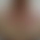 Retikulohistiozytose multizentrische: diffuse, unscharf begrenzte rote (Dermatomyositis-artige) P...