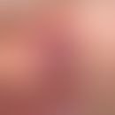 Eosinophiles Granulom der Haut: seltene Hautmanifestation;&nbsp;breitbasig aufsitzender, fleischi...