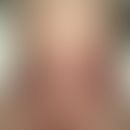 Abt-Letterer-Siwe-Krankheit: generalisertes "buntes" ekzematoides&nbsp;Krankheitsbild mit schuppe...
