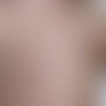 Abt-Letterer-Siwe-Krankheit:&nbsp;akute multifokale und multisystemische (disseminierte) Langerha...