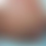 Hand-Schüller-Christian-Krankheit: akute, disseminierte&nbsp;Langerhans-Zell-Histiozytose. Abb. e...