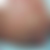 Hand-Schüller-Christian-Krankheit: akute, disseminierte&nbsp;Langerhans-Zell-Histiozytose. Abb. e...