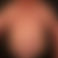 Gynäkomastie:&nbsp;ausgeprägte beidseitige Vergrößerung der Mammae bei einem 69-Jahre alten, männ...