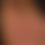 Stria cutis distensae bei exogenem Cushing-Syndrom.
