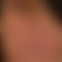 Atrophie der Haut (Striae cutis distensae): 63 Jahre alter Patient mit Striae cutis distensae bei...