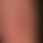 Atrophie der Haut: Striae cutis distensae. auffällig durchscheinende kleinere venöse Gefässe. Ält...