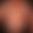 Adipositas bei exogenem Cushing-Syndrom mit Gynäkomastie&nbsp;und Striae cutis distensae.
