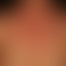 Dermatits, photoallergische: seit Wochen unangenehm juckende und spannende Hautveränderungen. Bek...