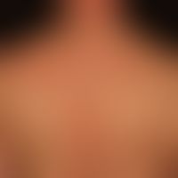 Seborrhoische Dermatitis des Erwachsenen (Detailaufnahme): landkartenartige, wenig symptomatische...