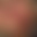 Hautmetastase: langzeitig vorbekanntes Plattenepithelkarzinom
