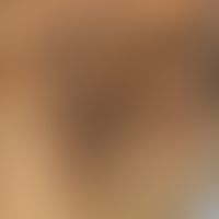 Erworbene filiforme Keratosis palmoplantaris. 68 Jahre alter Patient mit diffuser und punktierter...