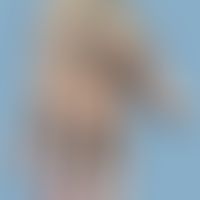 Erworbene filiforme Keratosis palmoplantaris. 68 Jahre alter Patient mit diffuser und punktierter...