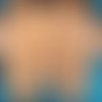 Tripe palms: diffuse, erworbene Palmarkeratose mit vertieften Handlinien. Bekanntes Adenokarzinom...