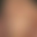 Acanthosis nigricans maligna: bräunliche mäßig schuppende, gering infiltrierte&nbsp;Plaques. Inte...