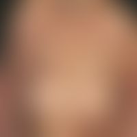 Acanthosis nigricans maligna: bräunliche mäßig schuppende, gering infiltrierte&nbsp;Plaques. Inte...