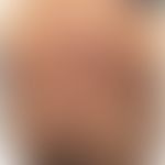 Pemphigoid bullöses (paraneoplastisch): Ausgedehntes therapieresistentes Pemphioid bei Nierenzell...